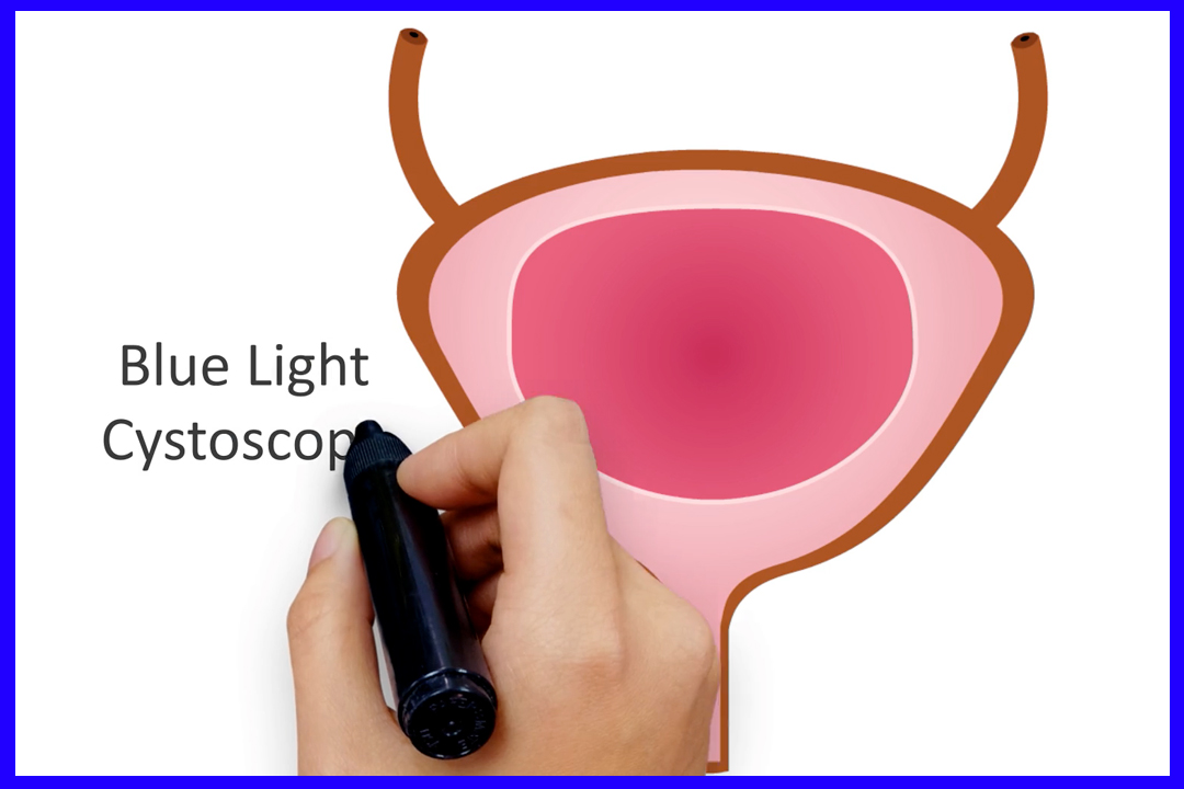 Bladder Cancer Visualization